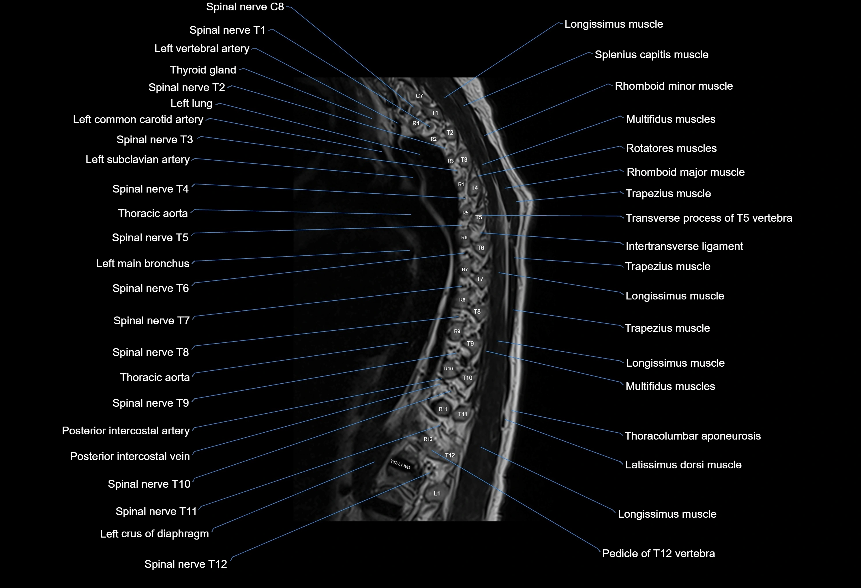 MRI thoracic spine sagittal  cross sectional anatomy 3T radiology  image-img-00001-00021.webp